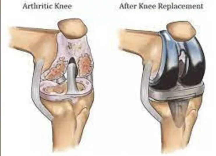 Posterior Offset Ring Lock Knee Joint prosthetic knee component for stability and controlled movement